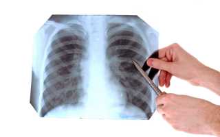 FOREIGN BODY REMOVAL from lungs